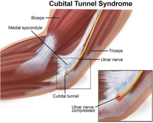 Cubital tunnel syndrome 300x241 1
