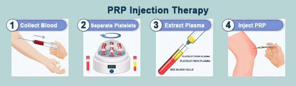 Platelet Rich Plasma Injection