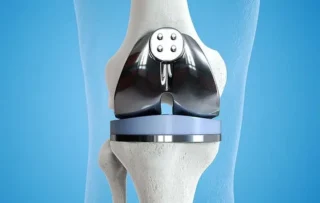 Total Knee Replacement San Diego